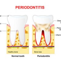 Laser Assisted Periodontal Therapy (LAPT) - Sterling Smile Dental Care